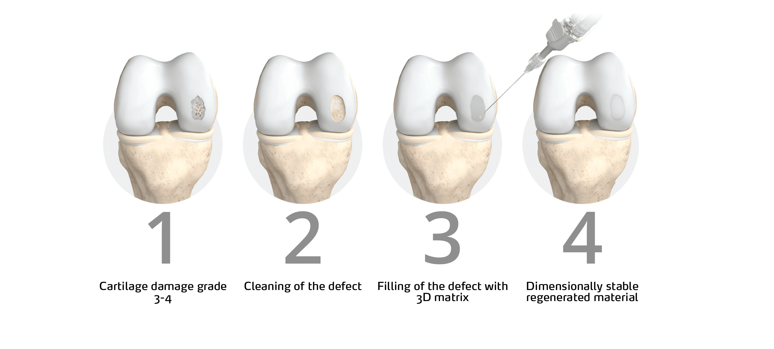 ChondroFiller treatment illustration 1